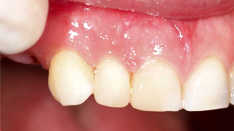dental-crowns-after