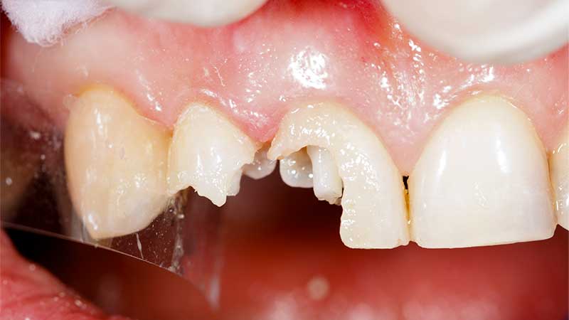 dental crowns before image