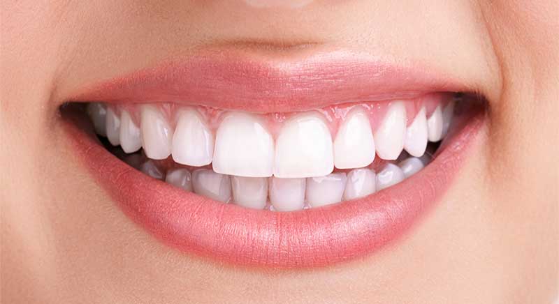 teeth whitening after image