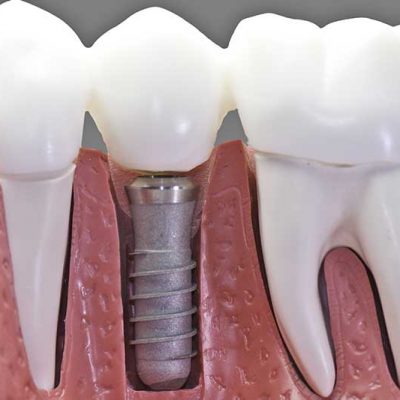 Why do dental implants fail