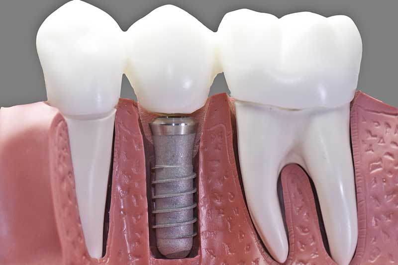 Why do dental implants fail