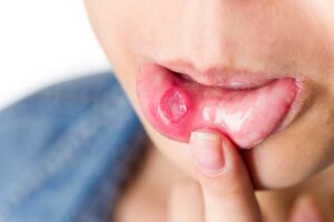 Canker Sores – Causes, Symptoms, and Cures