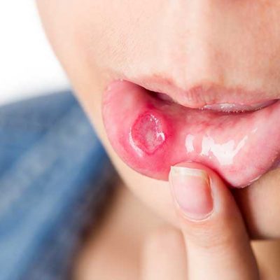 Canker Sores – Causes, Symptoms, and Cures