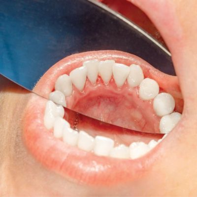 The Importance of Oral Cancer Screenings
