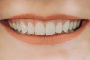 Common Misconceptions About Dental Veneers