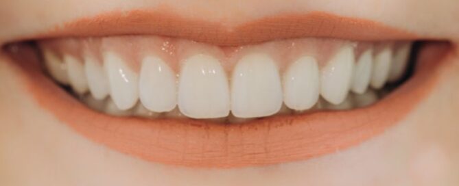 Common Misconceptions About Dental Veneers