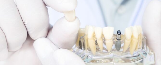 Top 5 Myths About Dental Implants Debunked