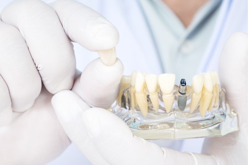 Top 5 Myths About Dental Implants Debunked
