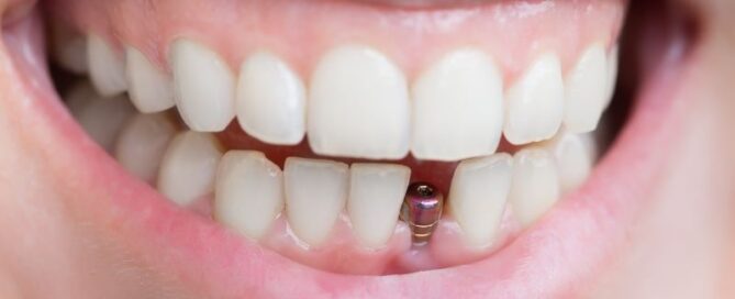 What To Expect After Removing a Dental Implant