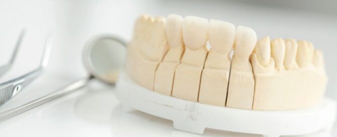 10 Things To Know Before Choosing To Get Porcelain Veneers