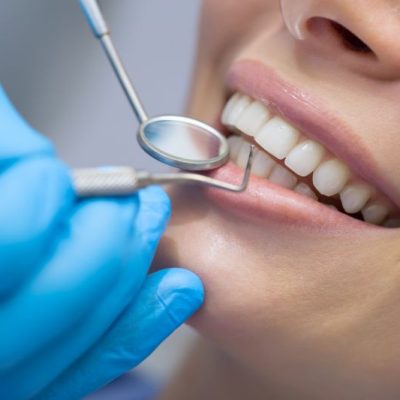 4 Cosmetic Solutions To Fix the Appearance of Small Teeth