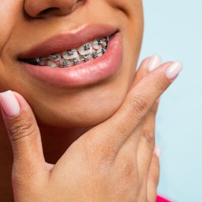 Orthodontic treatment. Teeth with braces